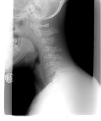 Votre ostéopathe à Paris 3 et à Paris 12 : Ostéopathie et névralgie cervico brachiale 